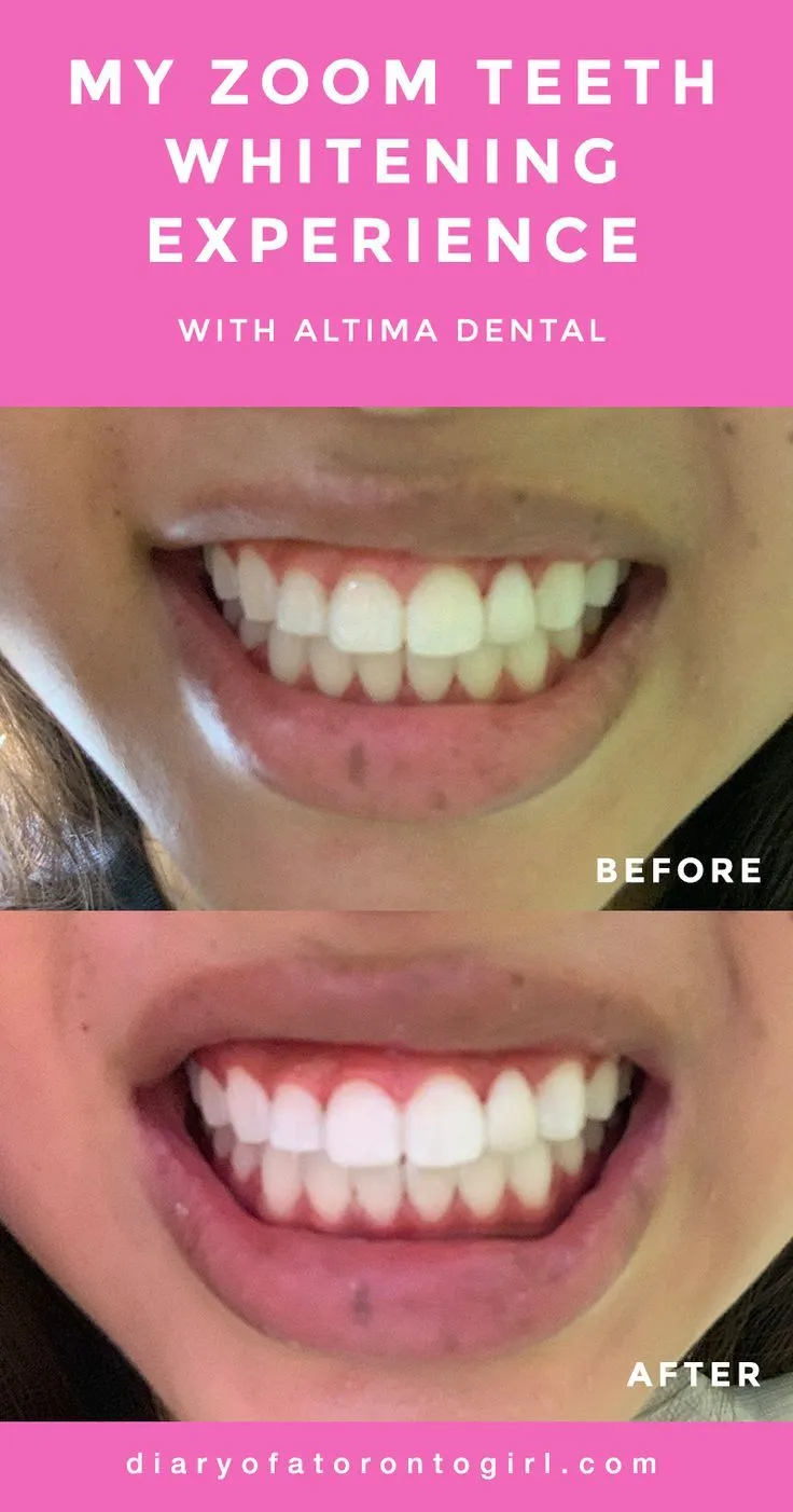 29480 teeth sensitivity