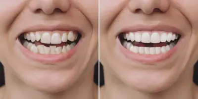 /img/29481-professional-teeth-whitening.webp