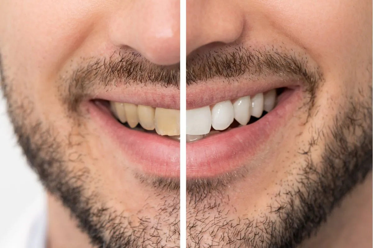 29483 foods to avoid after teeth whitening