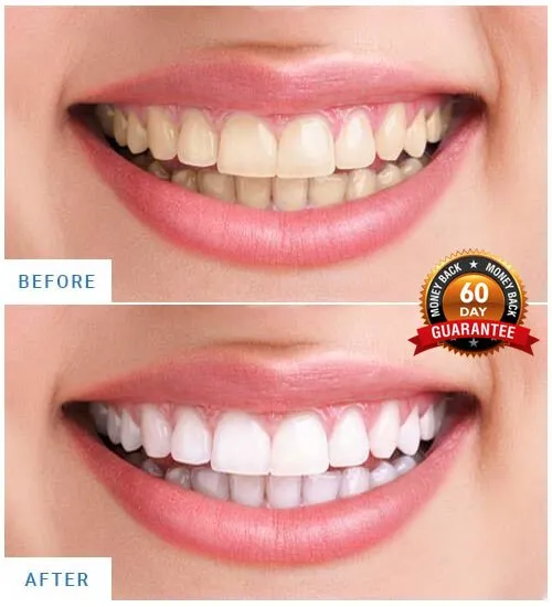 29486 teeth whitening dentist 3