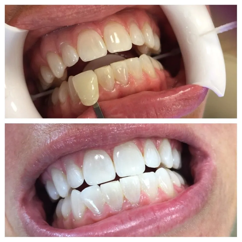 29486 teeth whitening procedure