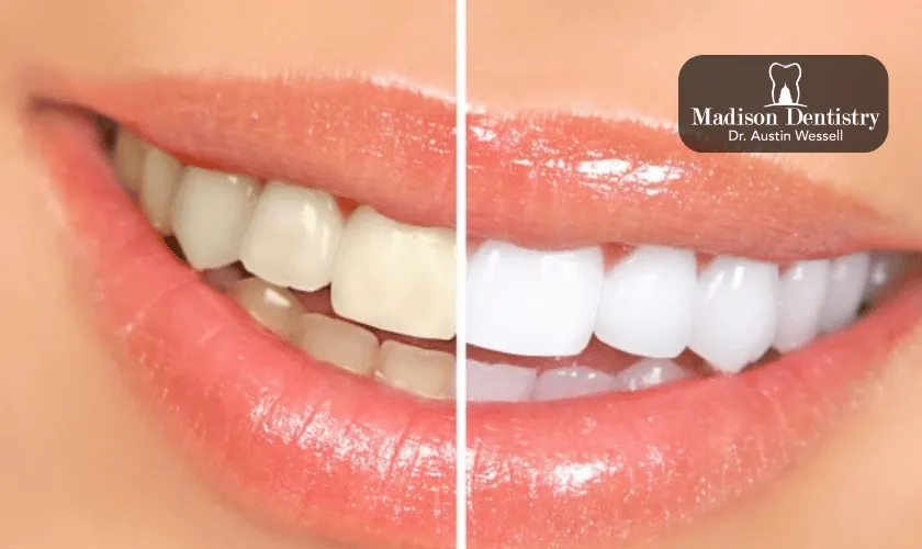 29489 teeth whitening appointment
