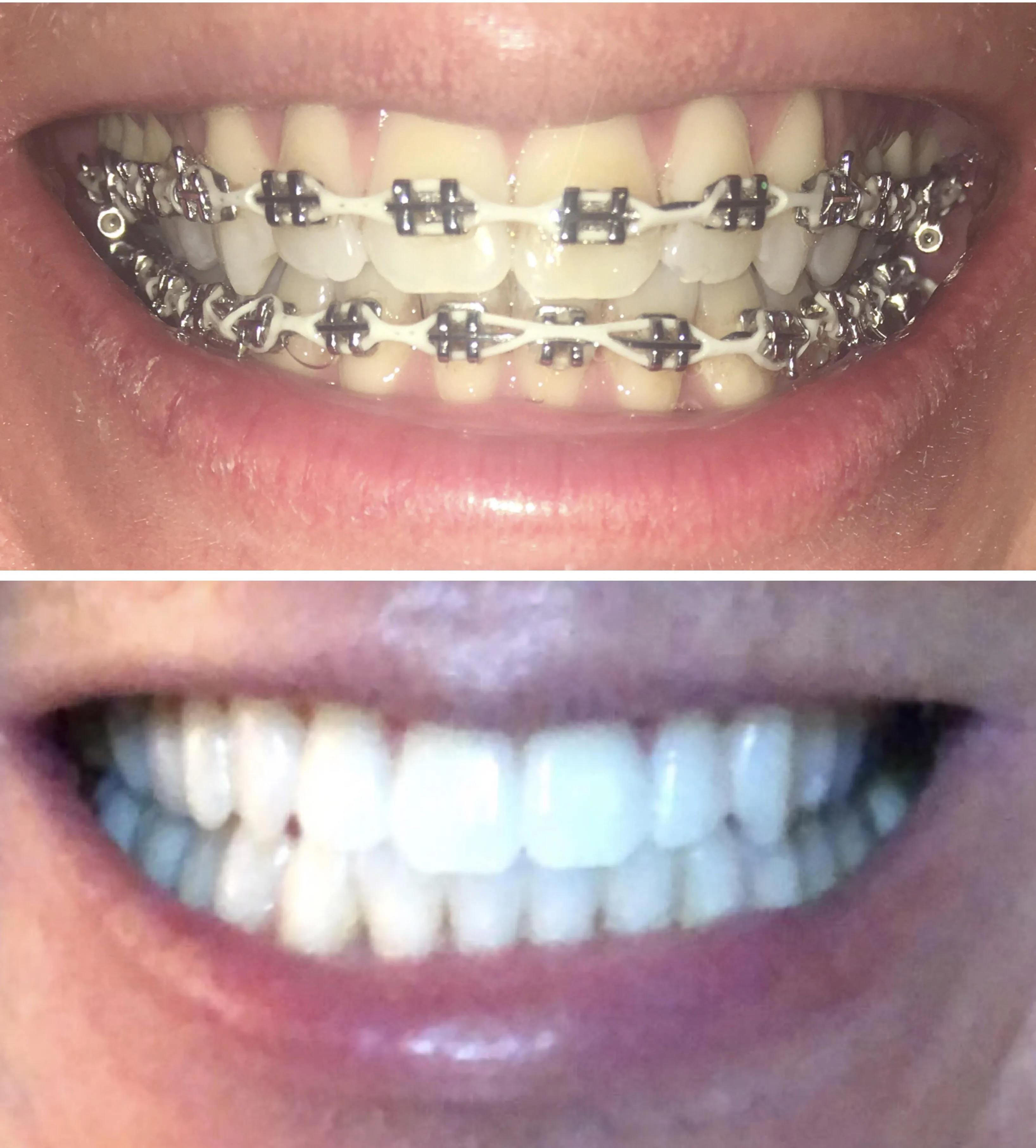 29491 teeth whitening with braces at home image1