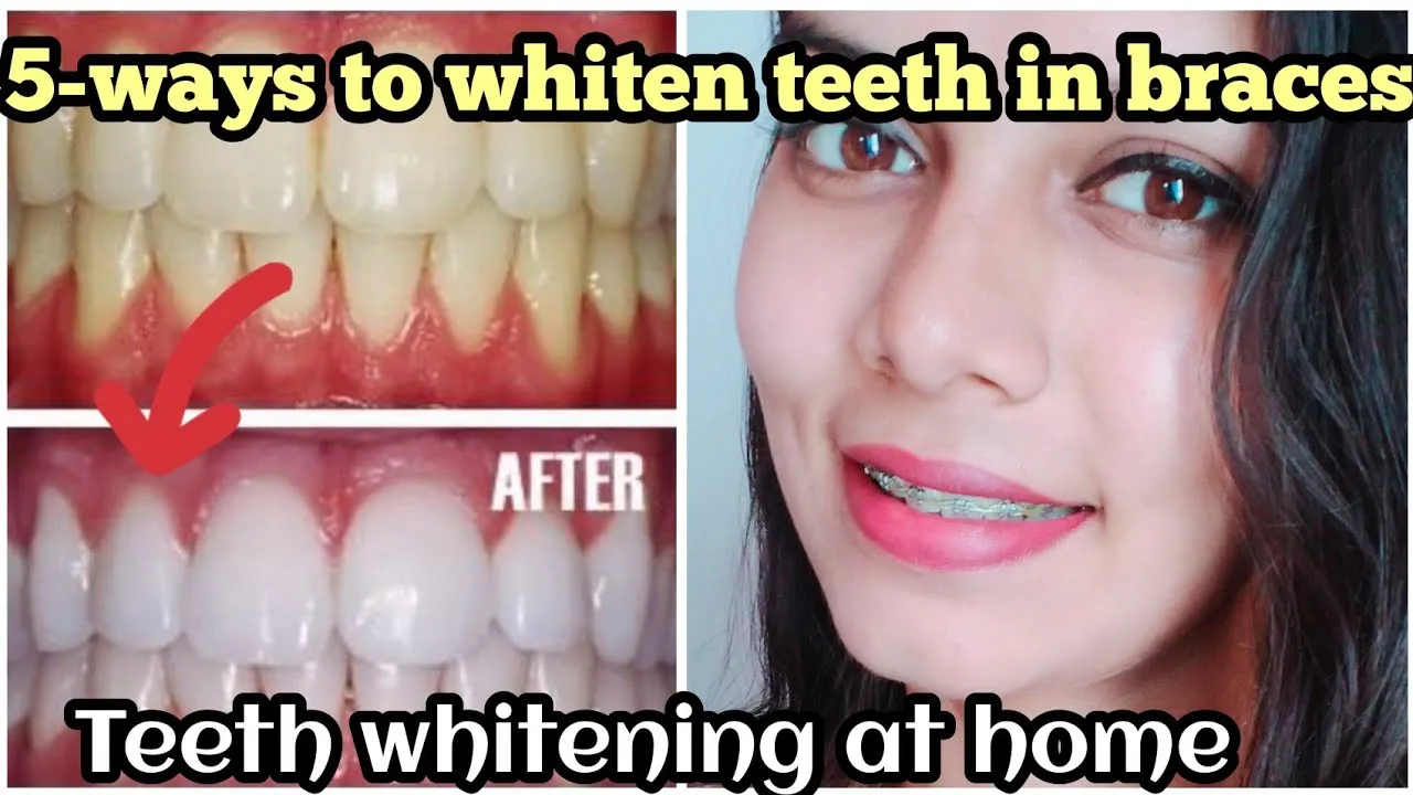 29491 teeth whitening with braces at home image2