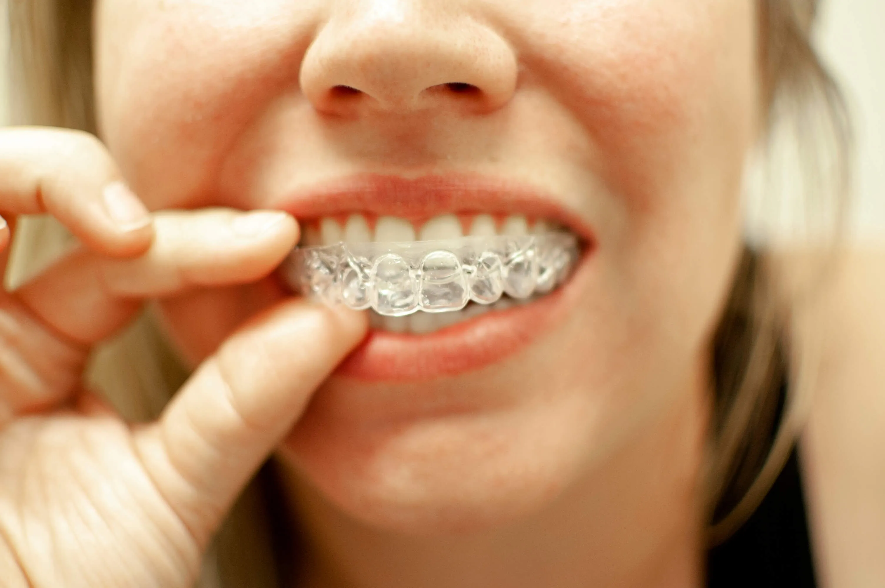 29491 teeth whitening with braces at home image4