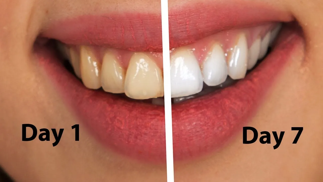 29491 teeth whitening with braces at home image5