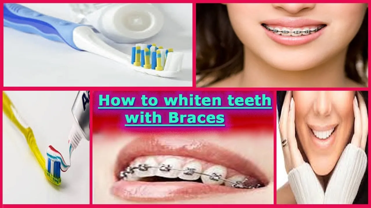 29491 teeth whitening with braces at home image6