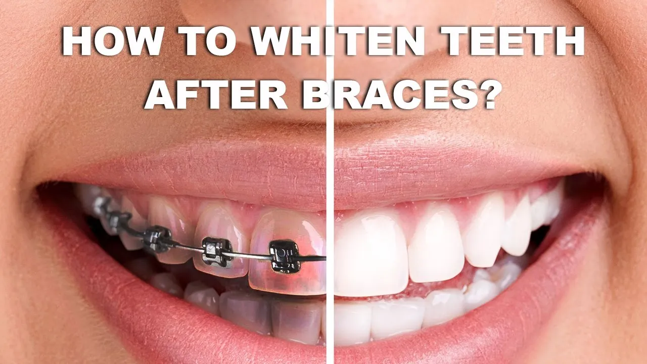 /img/29491-teeth-whitening-with-braces-at-home-image7.webp