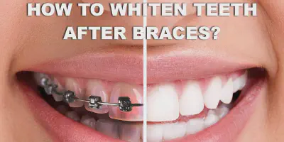 /img/29491-teeth-whitening-with-braces-at-home-image7.webp