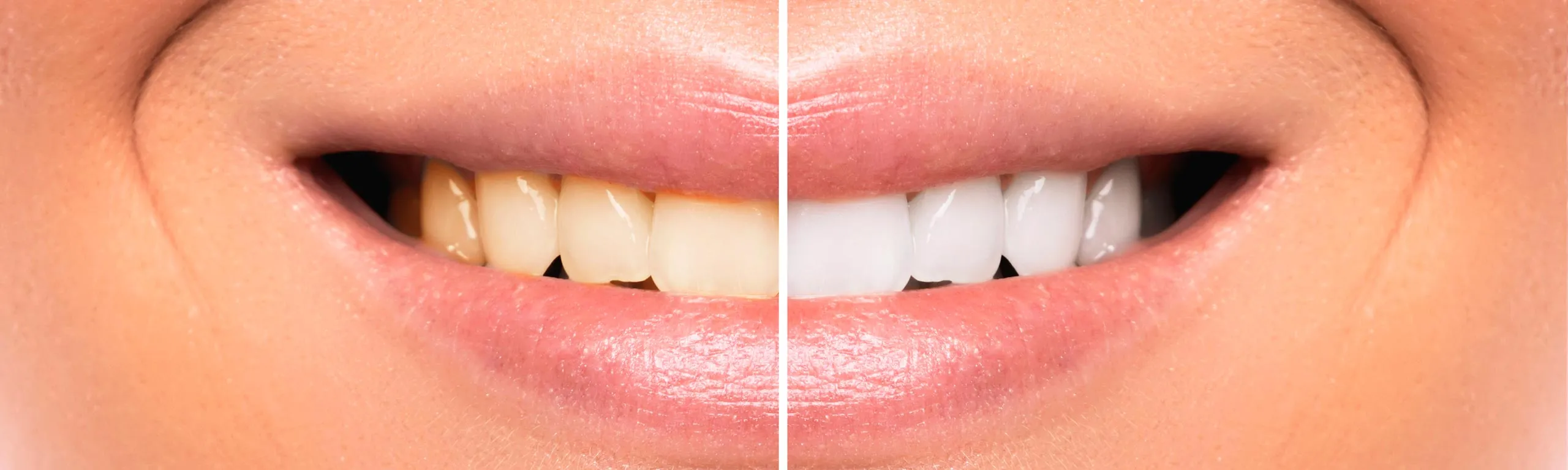 29492 bright smile teeth whitening