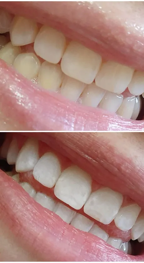 29492 home teeth whitening kits