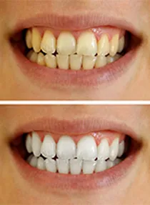 29492 in office teeth whitening