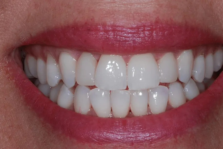 29492 maintaining teeth whitening