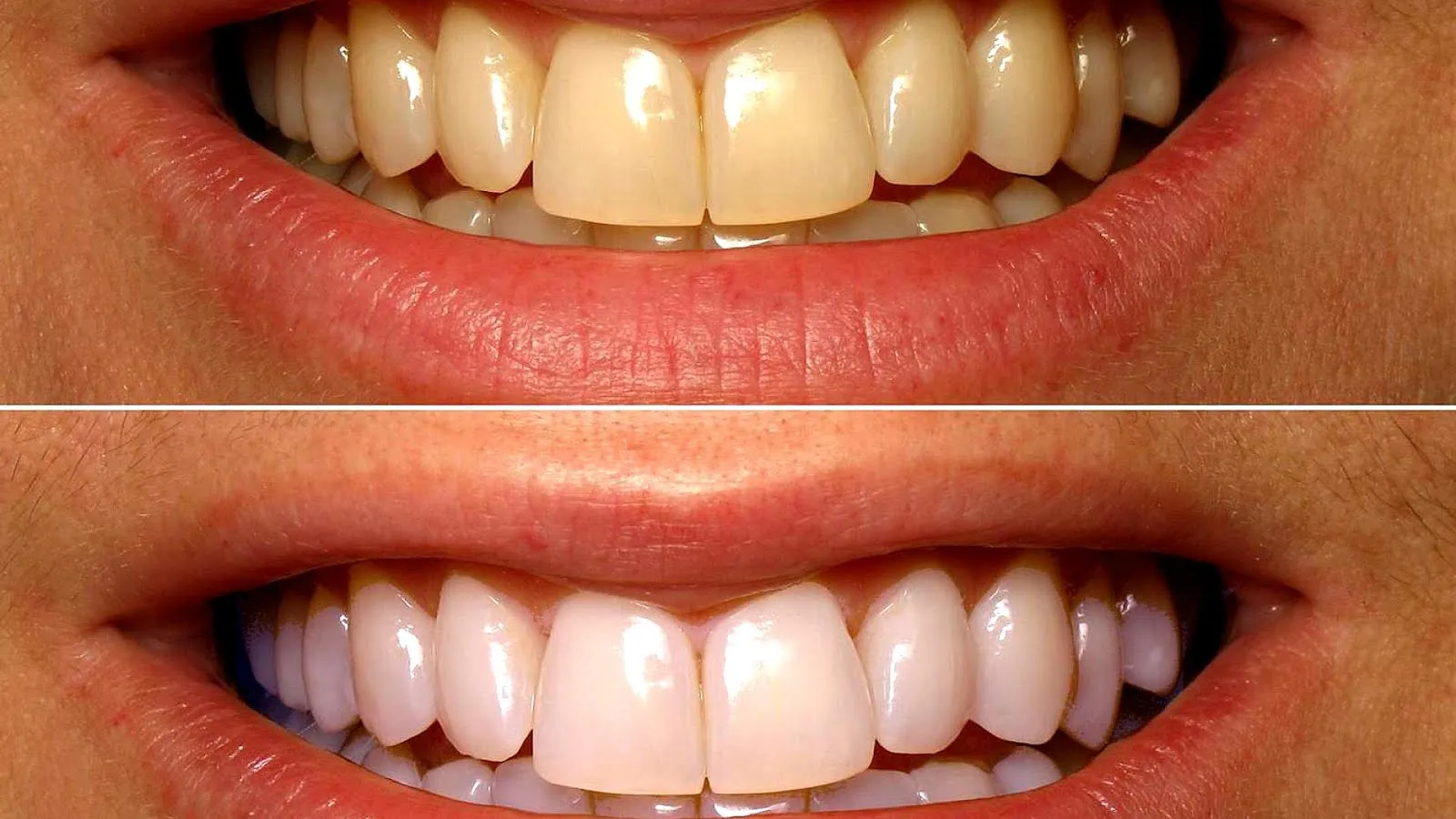 /img/29494-teeth-whitening-kumasi-diet.webp
