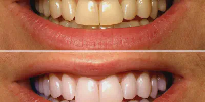/img/29494-teeth-whitening-kumasi-diet.webp