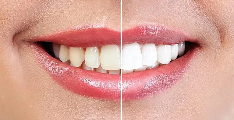 29501 professional teeth whitening