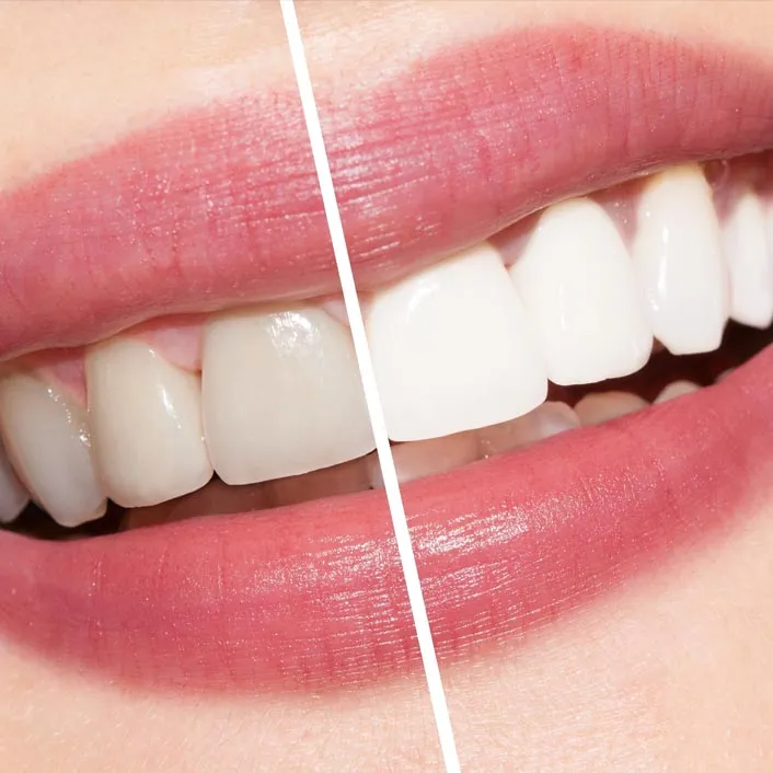 29501 teeth whitening procedure