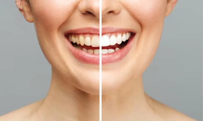 29502 teeth whitening diet