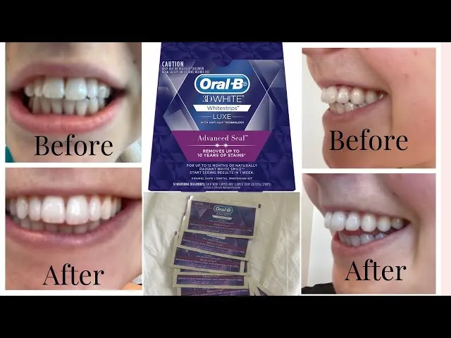 29505 comparing teeth whitening