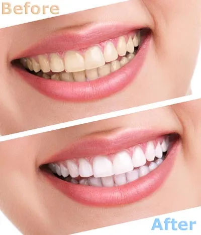 29512 at home teeth whitening