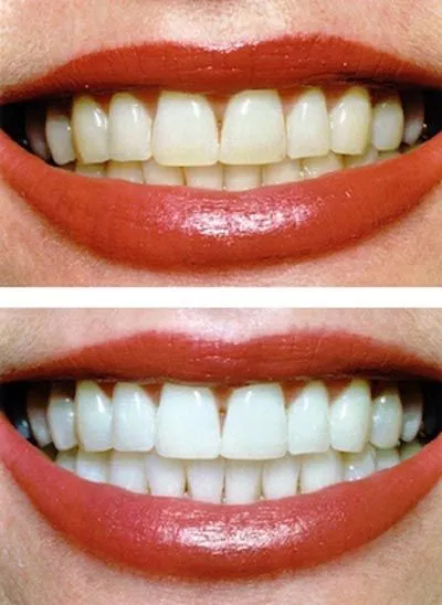 29512 in office teeth whitening