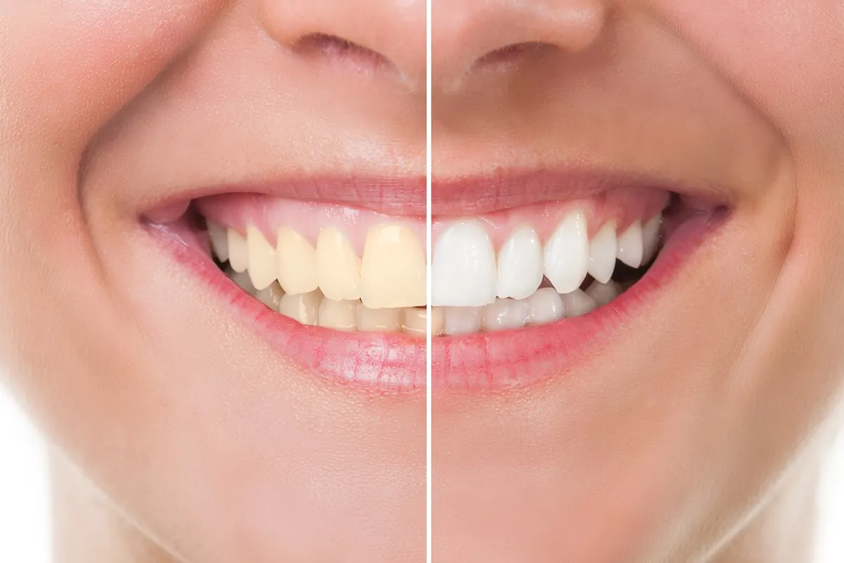 29514 teeth whitening customized treatment