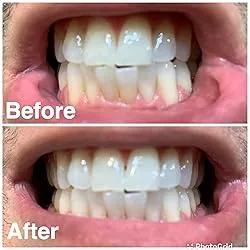 29515 teeth whitening aftercare