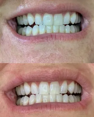 29516 take home teeth whitening