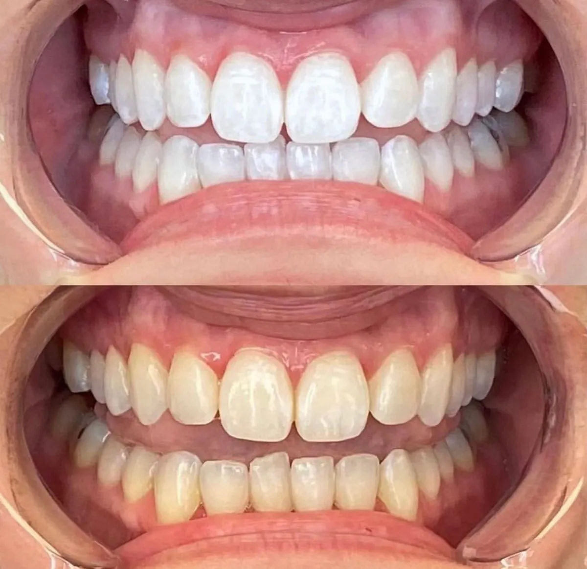 29516 teeth whitening results