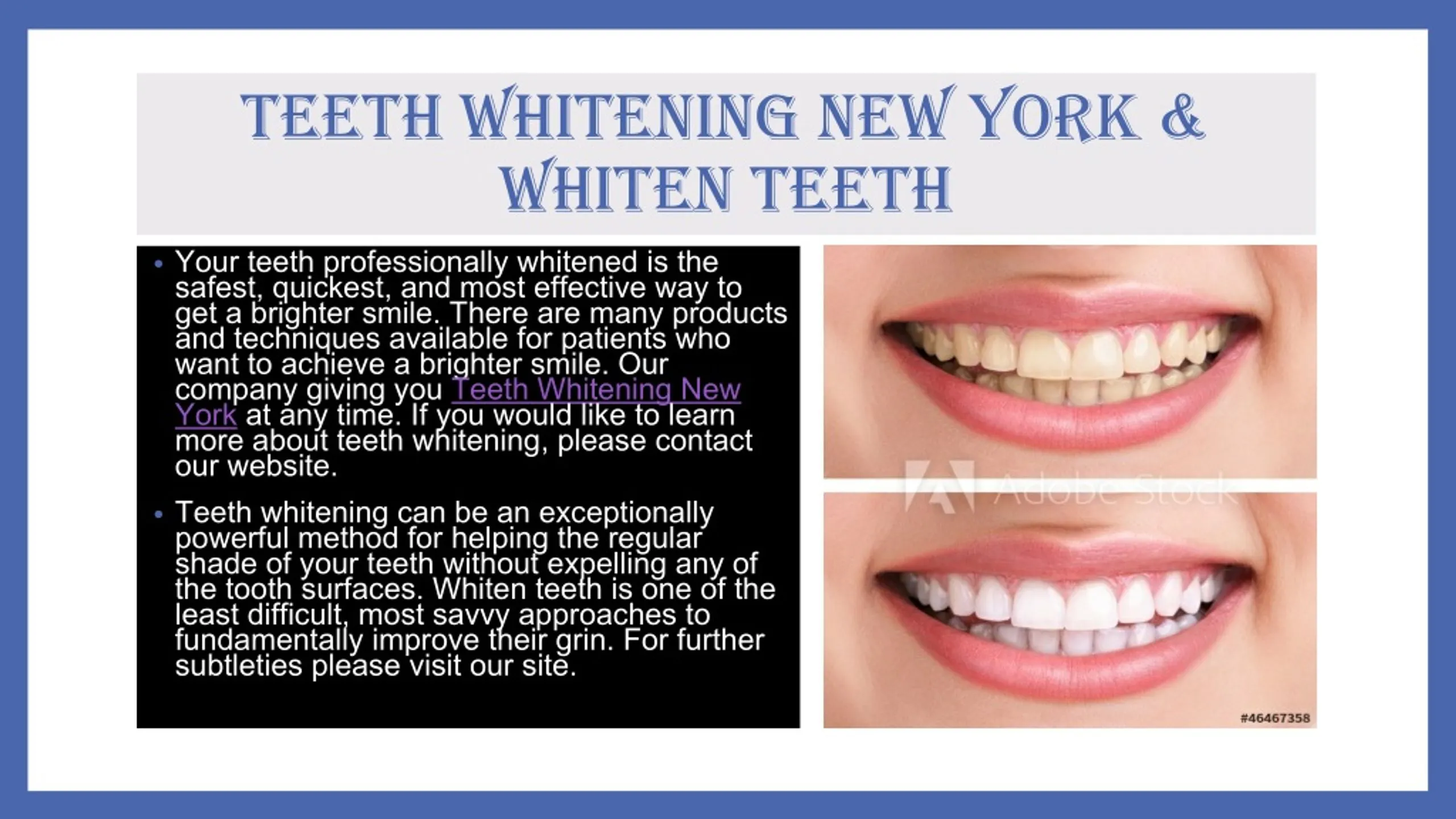 29517 take home whitening kit