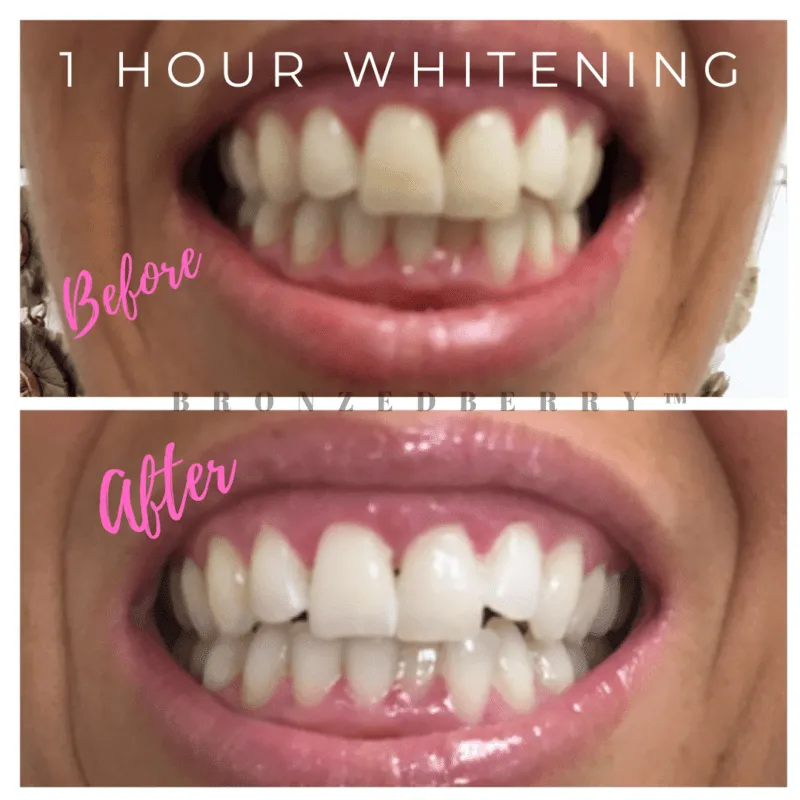 29521 teeth whitening procedure