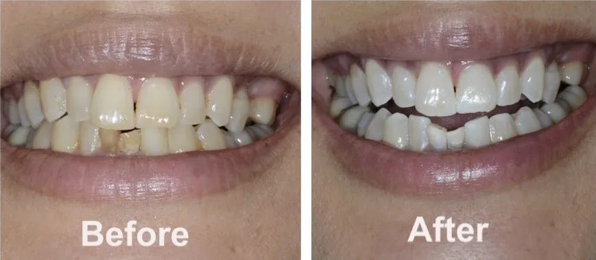29523 zoom teeth whitening dentist