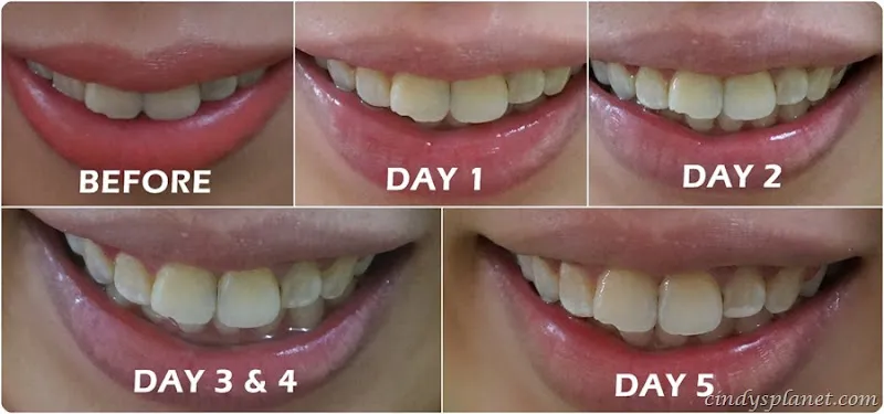 29526 opulence teeth whitening oral hygiene