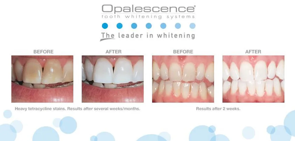 29526 opulence teeth whitening teeth anatomy