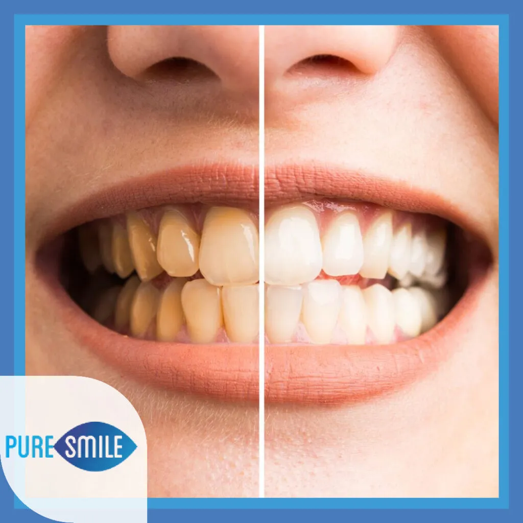 29527 puresmile teeth whitening procedure