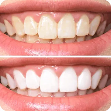 29534 teeth whitening diet