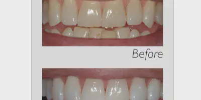 /img/29537-teeth-whitening-results.webp