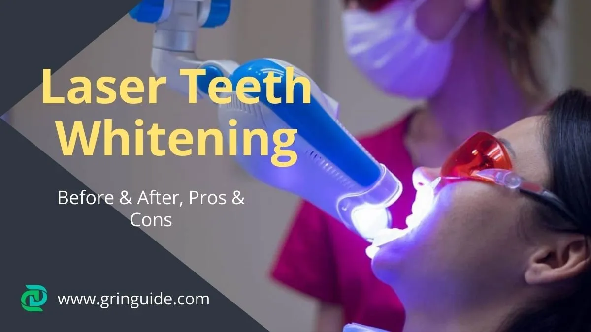 29538 laser teeth whitening cost