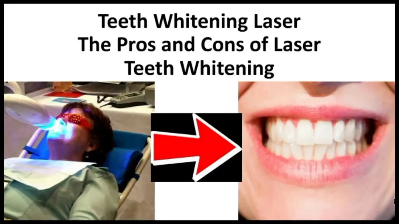 29538 laser teeth whitening results
