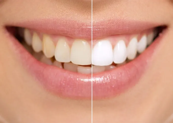 29540 professional teeth whitening