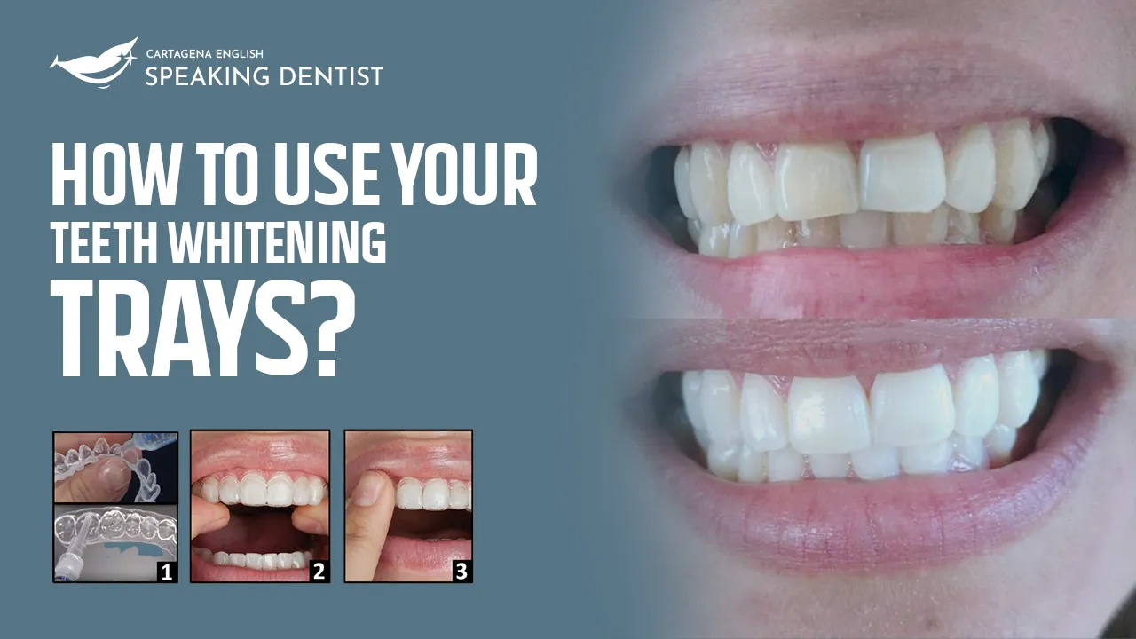 29541 custom teeth whitening trays