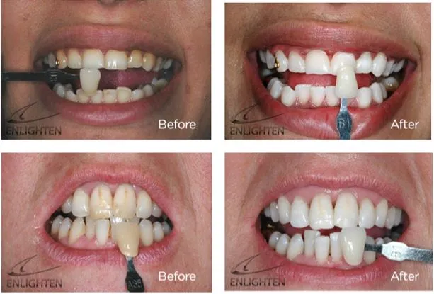 29541 pre filled whitening trays