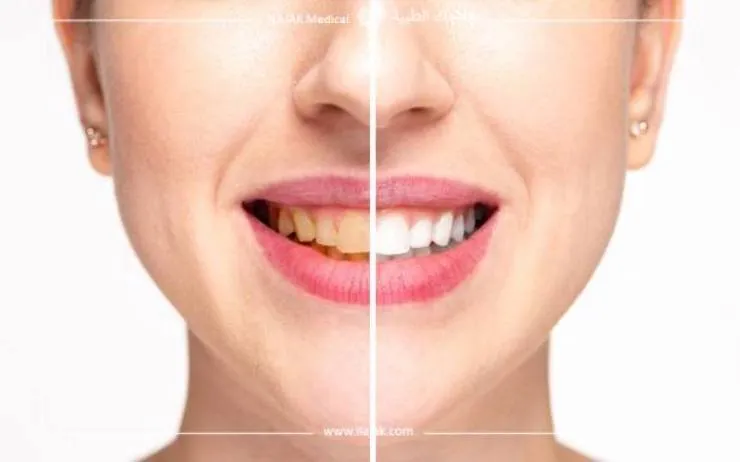 /img/29541-teeth-whitening-maintenance.webp