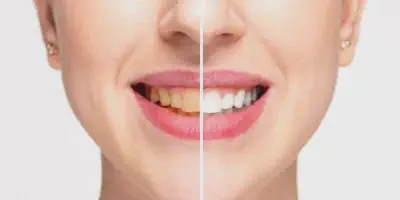 /img/29541-teeth-whitening-maintenance.webp