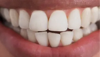 29544 teeth whitening mansfield before after