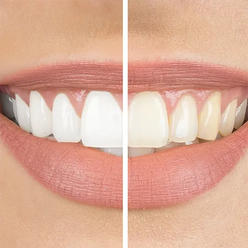 29545 home teeth whitening