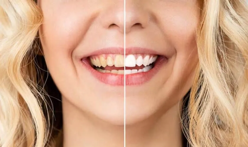 29545 teeth whitening foods