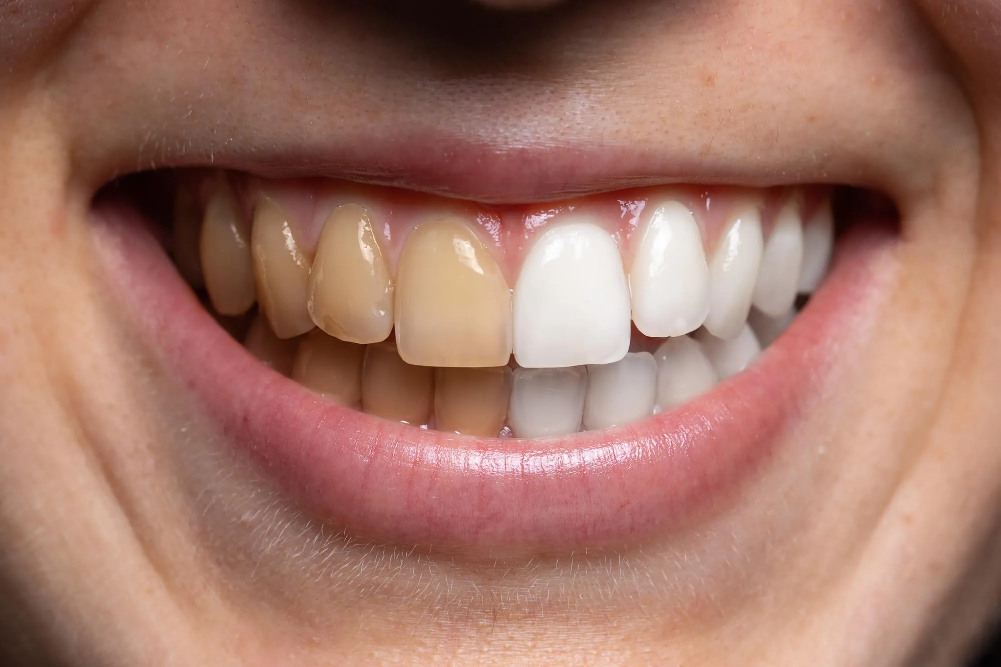 29547 teeth whitening pembroke pines 6