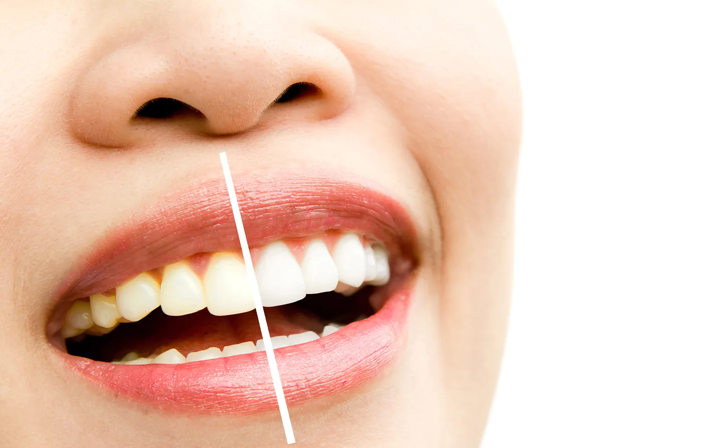 29547 teeth whitening pembroke pines 7