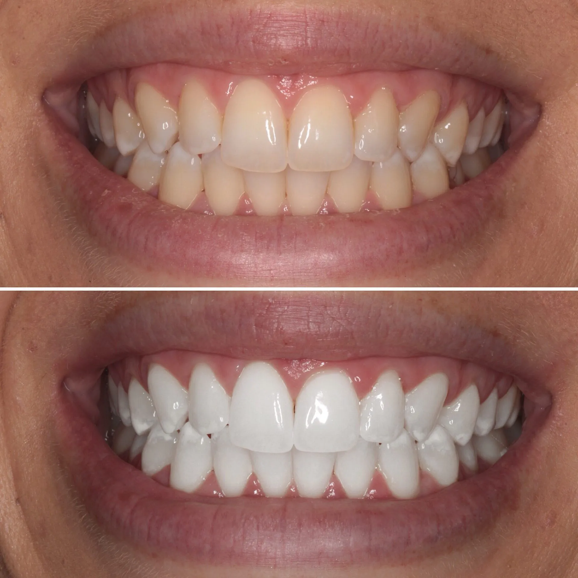 29549 dental veneers